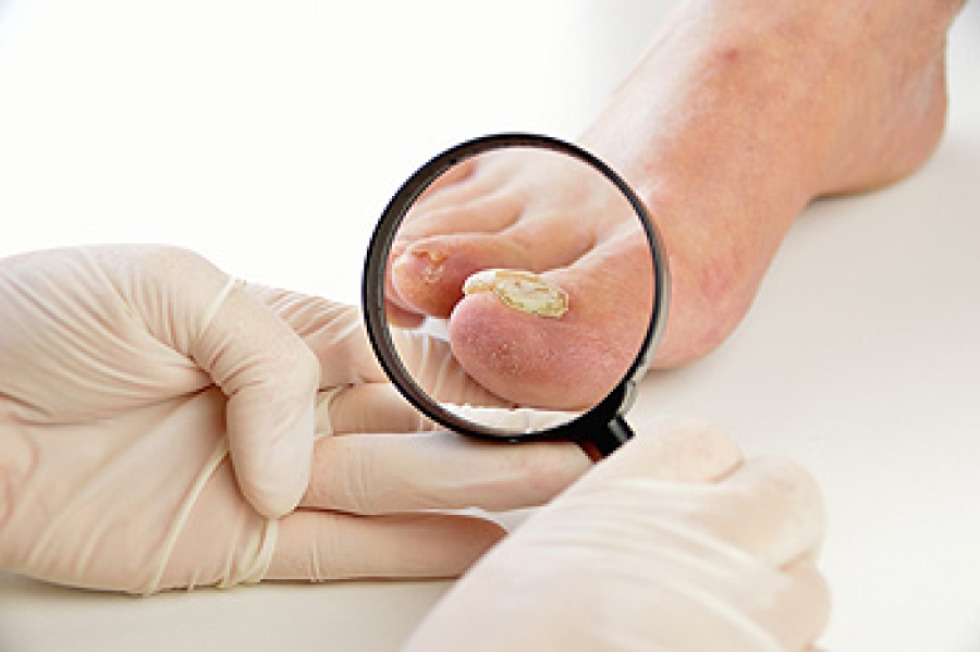 Topical Treatments Options for Toenail Fungus